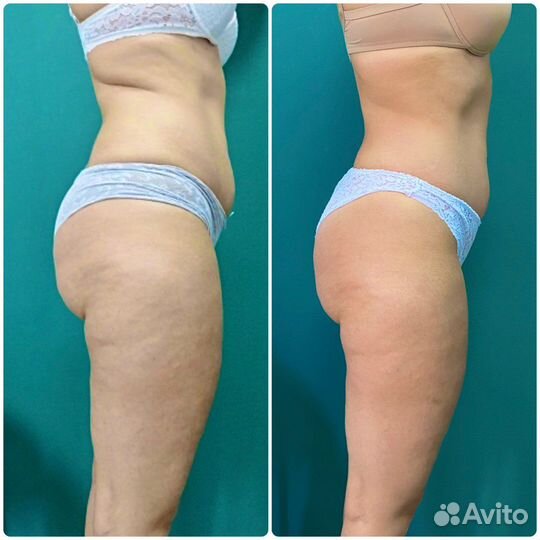 Роликовый массаж сферами