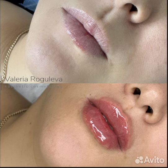 Модель на увеличение губ