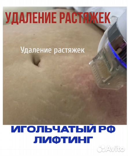 Удаление растяжек живот