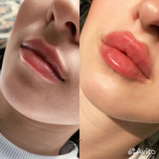 Волосы, пм бровей, губ, кп губ, ботокс