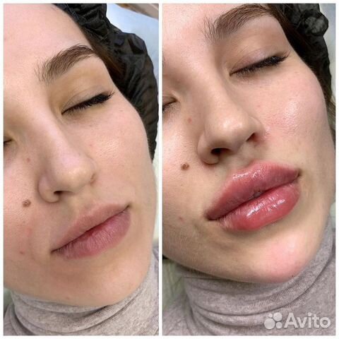 Модели на увеличение губ