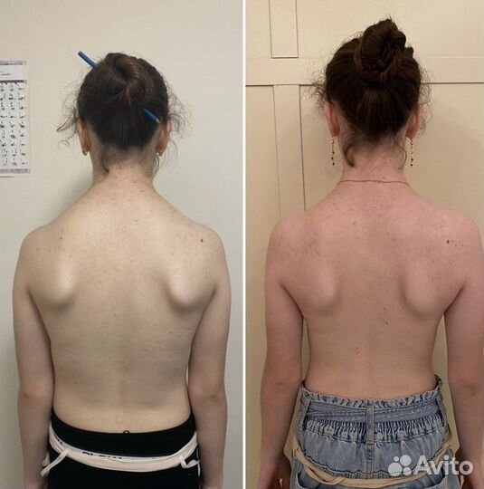 Коррекция осанки,устранение болей зажимов или спаз