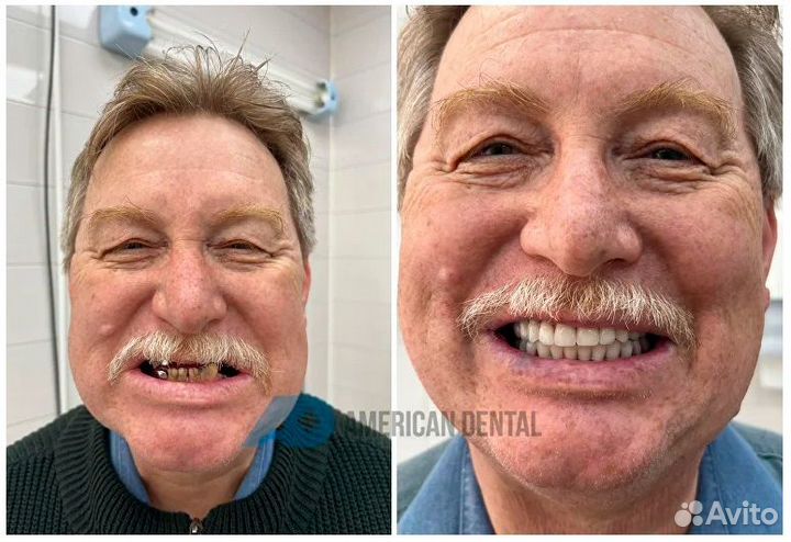 Постоянный протез + 4 импланта (ALL on 4)