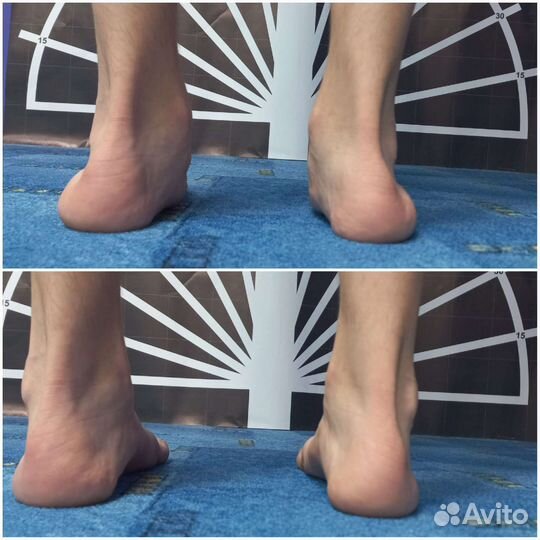 Плоскостопие, позвоночник, реабилитация