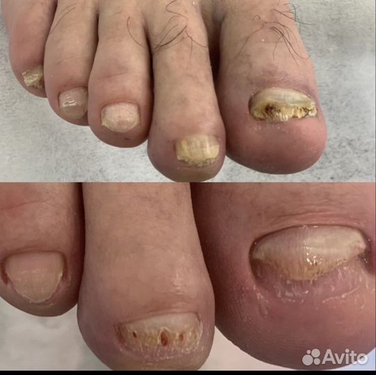 Лазерное лечение грибка ногтей и кожи