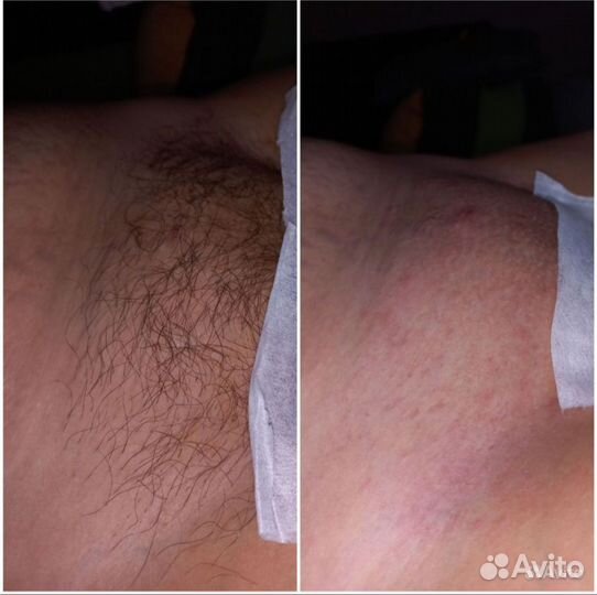 Восковая депиляция