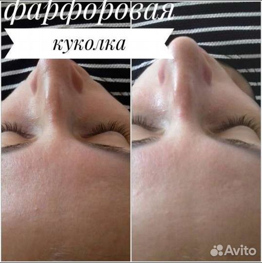 Чистка лица,пилинги