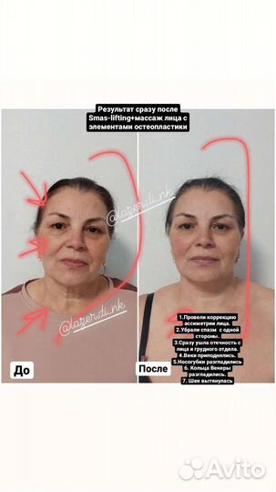 Лазерная эпиляци, холодная плазма, массаж