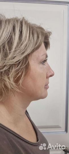 Смас лифтинг