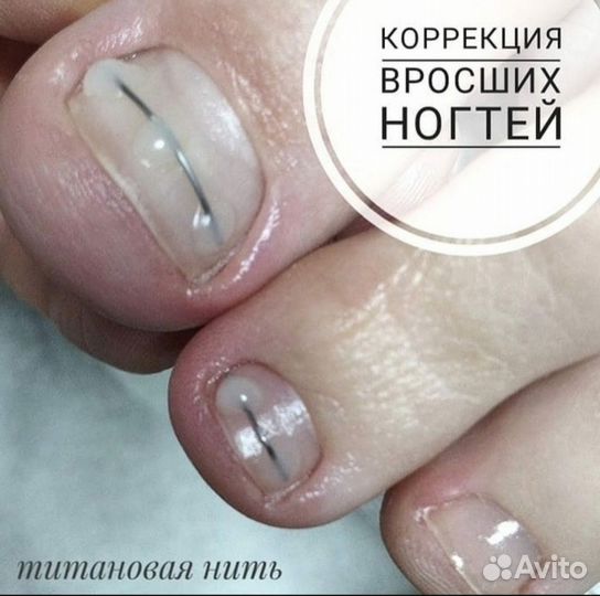 Педикюр парамедицинский, подолог