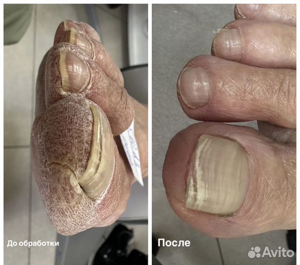 Подолог, педикюр