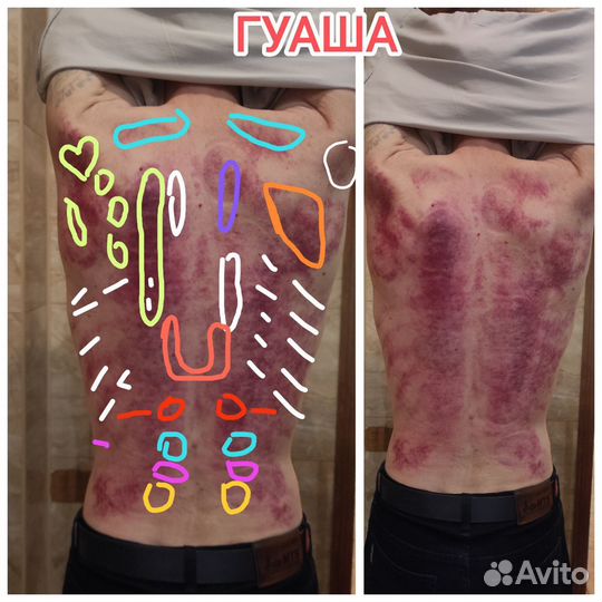 Массаж гуаша