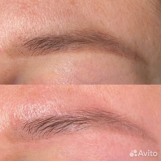 Удаление татуажа перманента ремувером