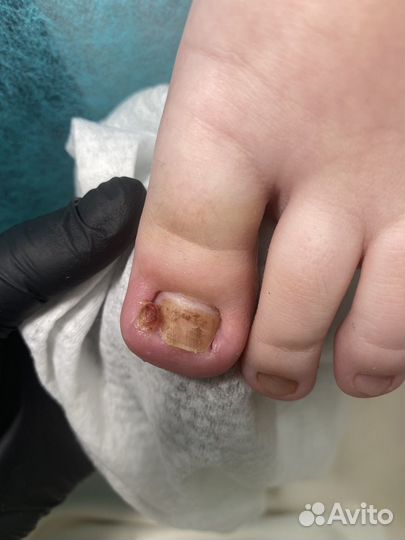 Вросший ноготь