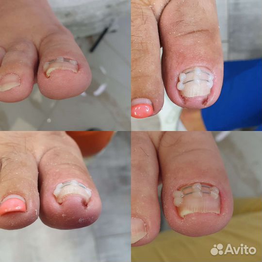 Педикюр любой сложности.Выезд на дом