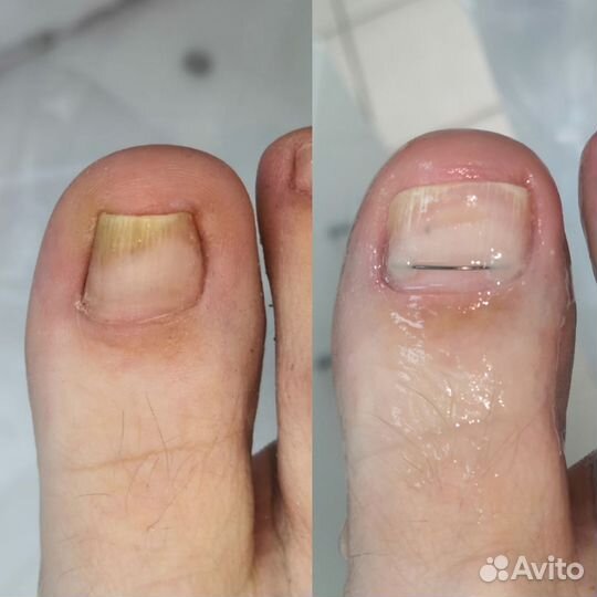 Титановая нить