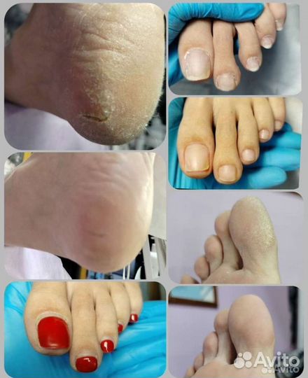 Смарт- педикюр (дисками)зачистка ногтей онихолизис