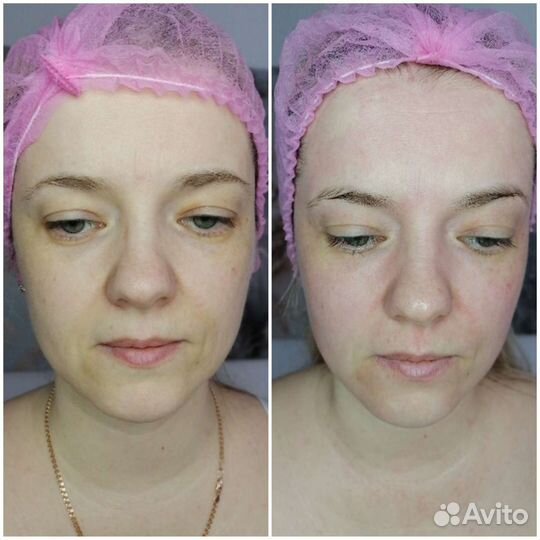 Flaxlift для омоложения лица