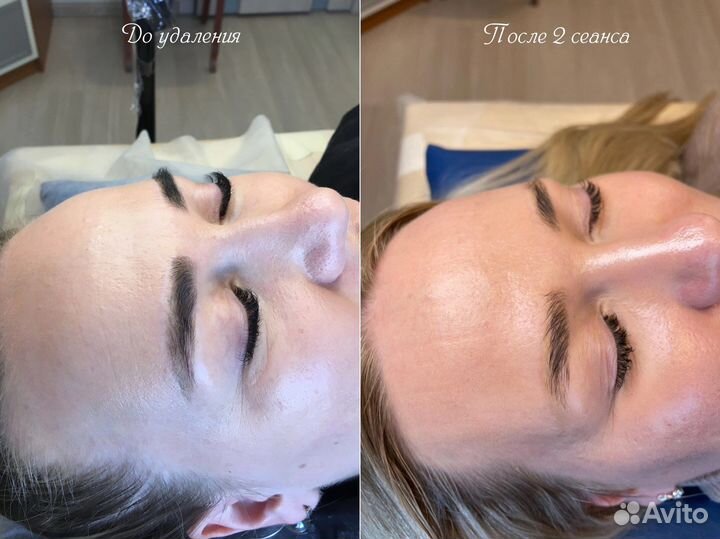 Удаление Татуажа и Тату без Шрамов и Ожогов