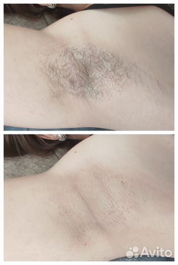 Депиляция воском