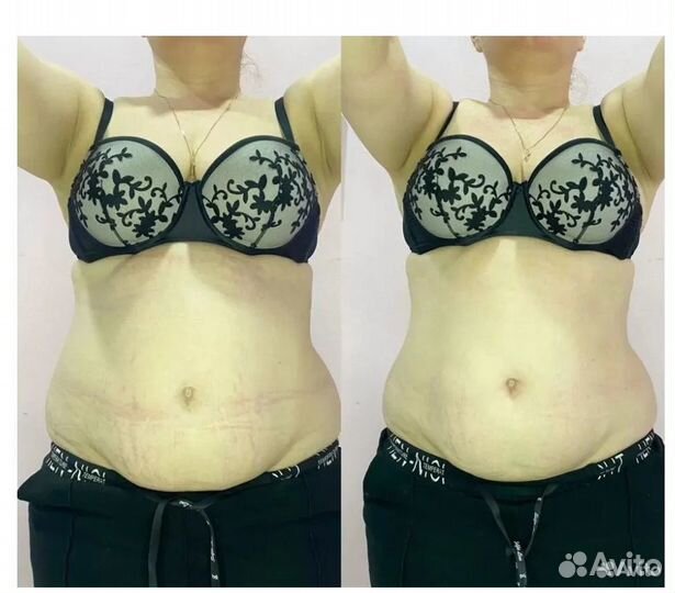 Липосакция без операции в Тольятти