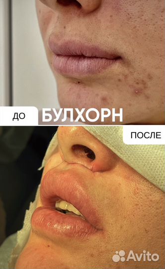 Булхорн броулифтинг