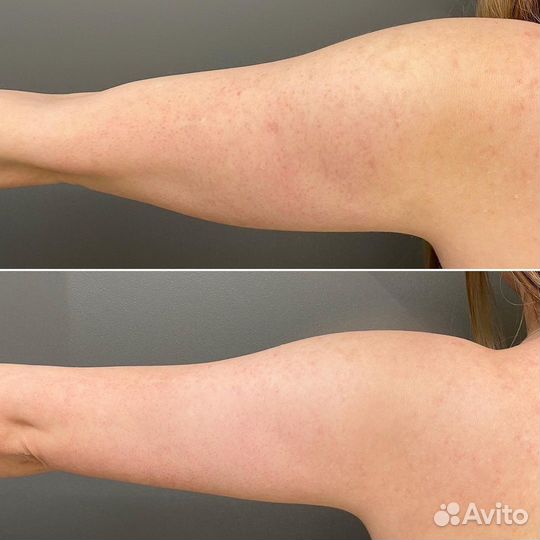 Модели на Криолиполиз Рук