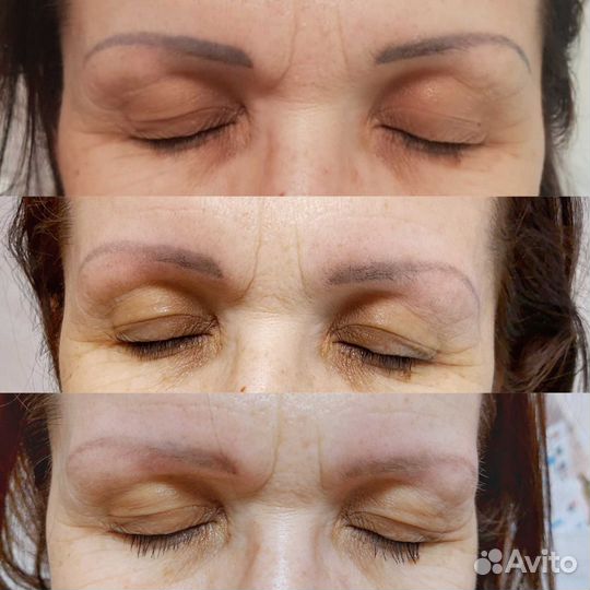 Удаление татуажа бровей лазером