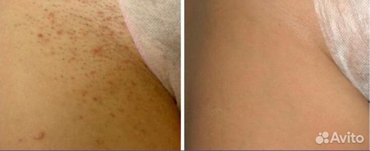 Лазерная эпиляция Элос