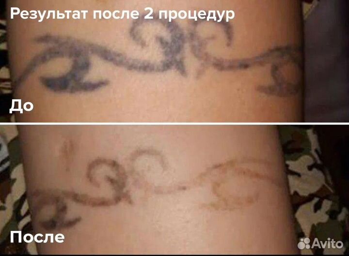 Удаление тутуировок и татуажа