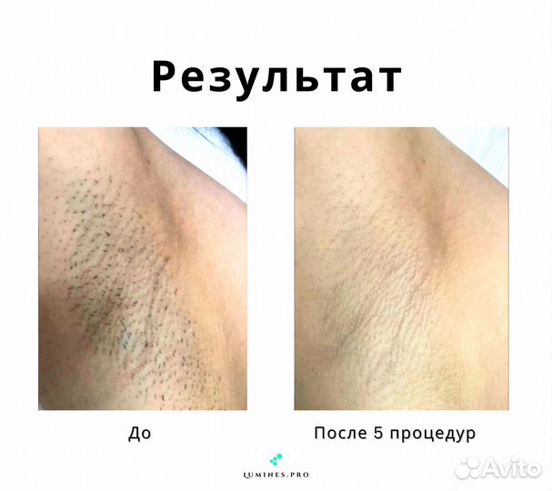 Аппарат для эпиляции Lumines-M Макс’Ван 1200