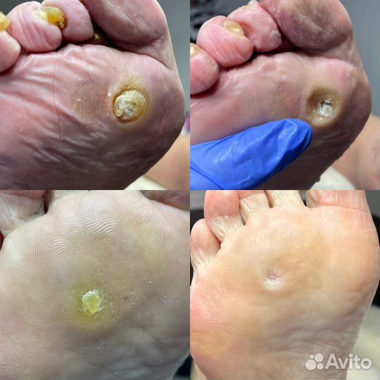 Подолог. Сложный педикюр, диабет, грибок