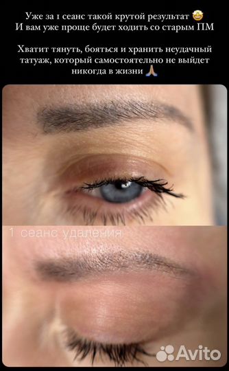 Лазерное удаление тату и татуажа бровей