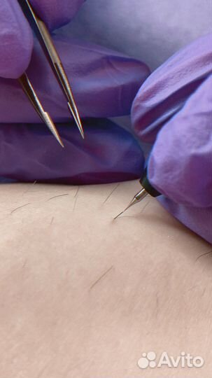 Электроэпиляция