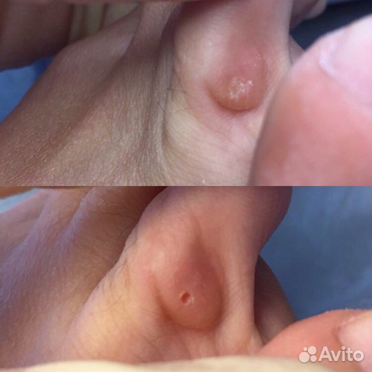 Медицинский аппаратный педикюр