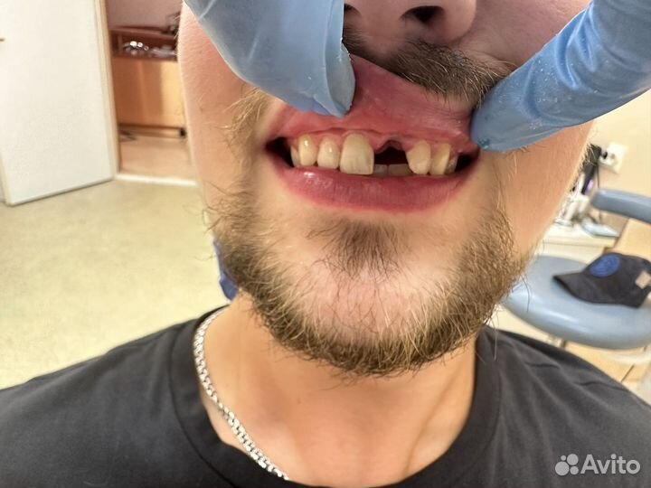 Съемное протезирование