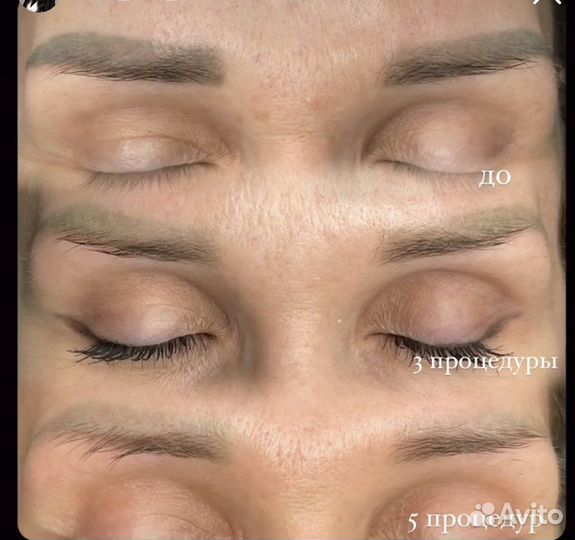 Удаление татуажа и тату