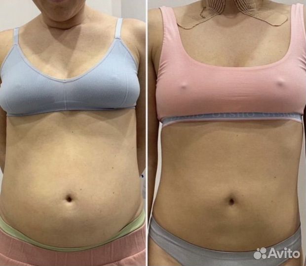 Модель на криолиполиз быстрое похудение