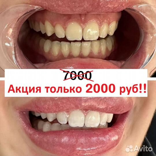 Отбеливание зубов