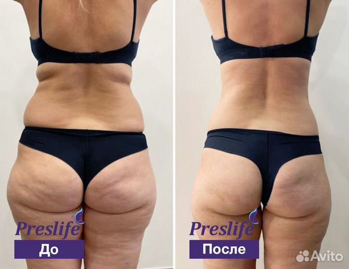 Aппaрaтная коppекция фигуры. Плоский живoт