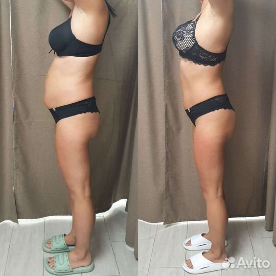 Криолиполиз,коррекция фигуры,похудение