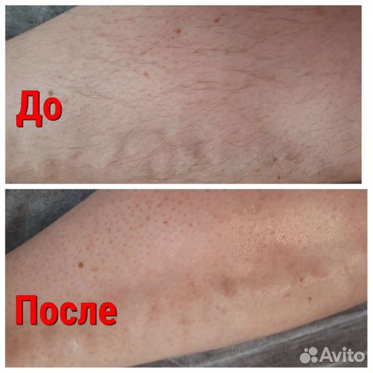 Шугаринг /Депиляция воском/Челябинск Северо запад