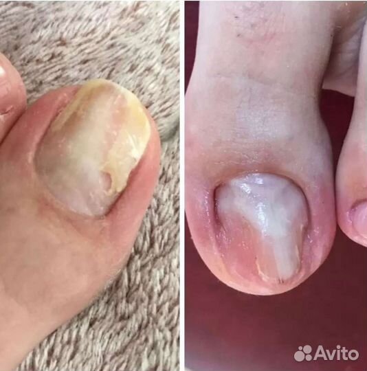 Подолог есть выезд, грибки вросшие ногти и др