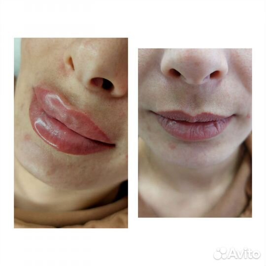 Увеличение губ косметология ботокс
