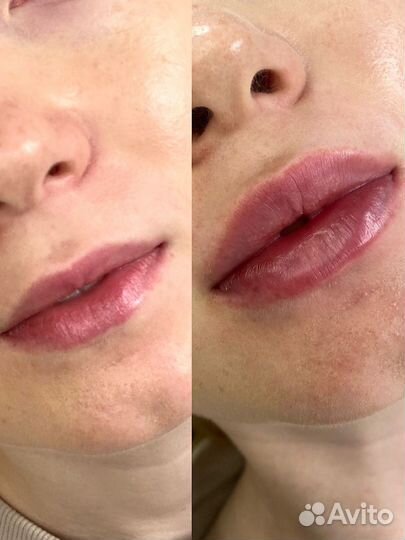 Врач косметолог/ Увеличение губ/ Ботокс