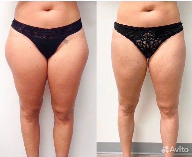 Прессотерапия