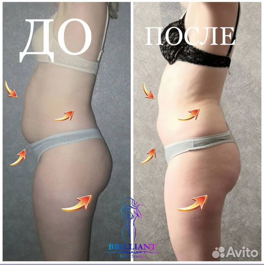 Вакуумный массаж, Кавитация, RF лифтинг