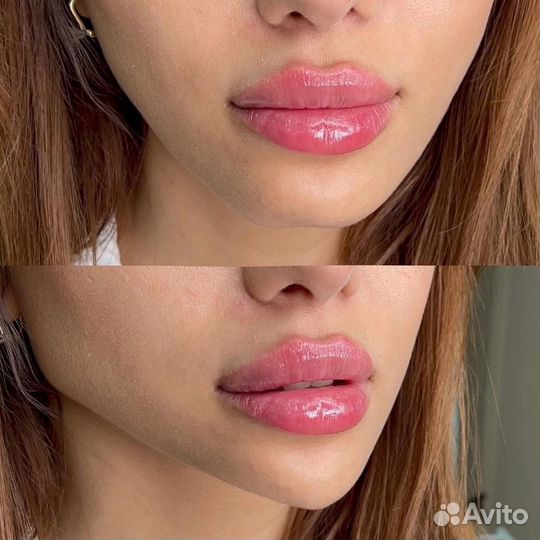 Косметолог. Контурная пластика, лицо под ключ