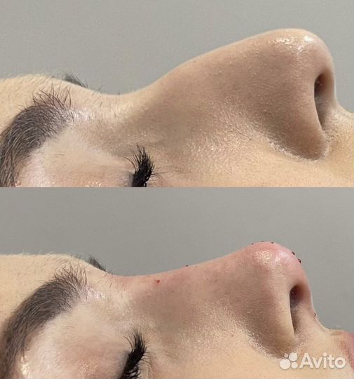 Коррекция формы носа, ринопластика без операции