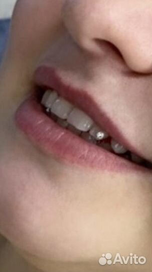 Установка скайсов (кристаллов) на зубы